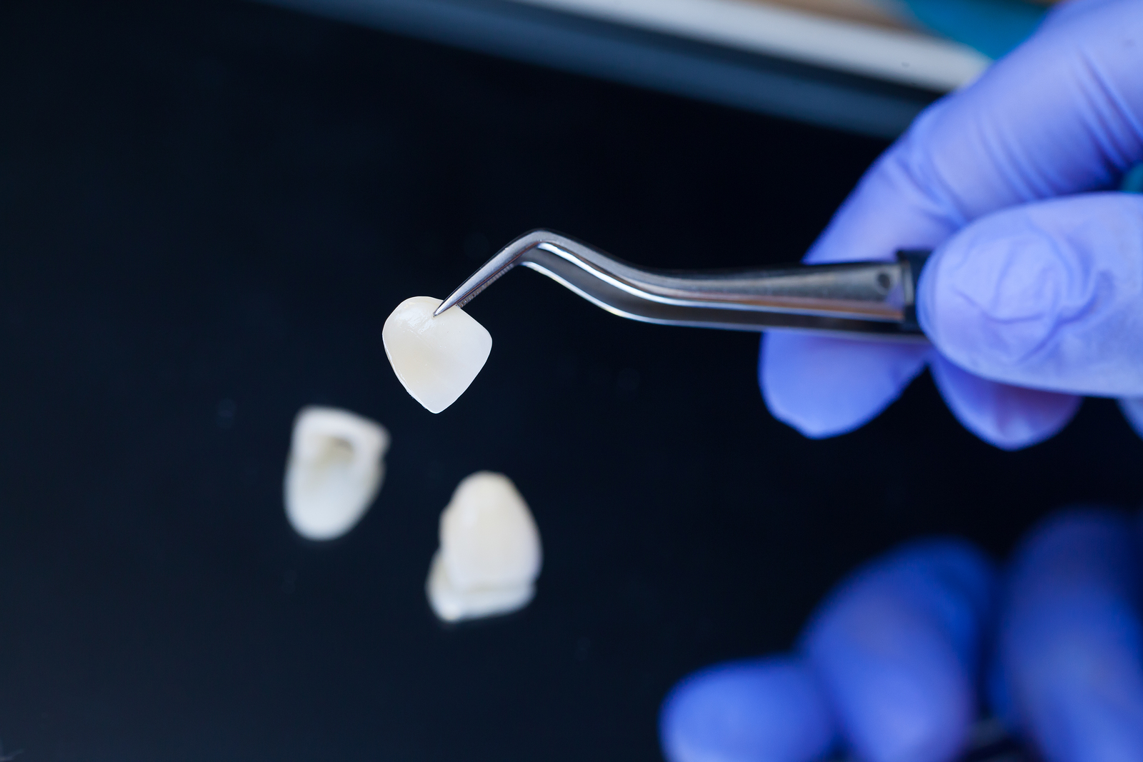 How Veneers Are an Effective Way to Attain the Smile of your Dreams