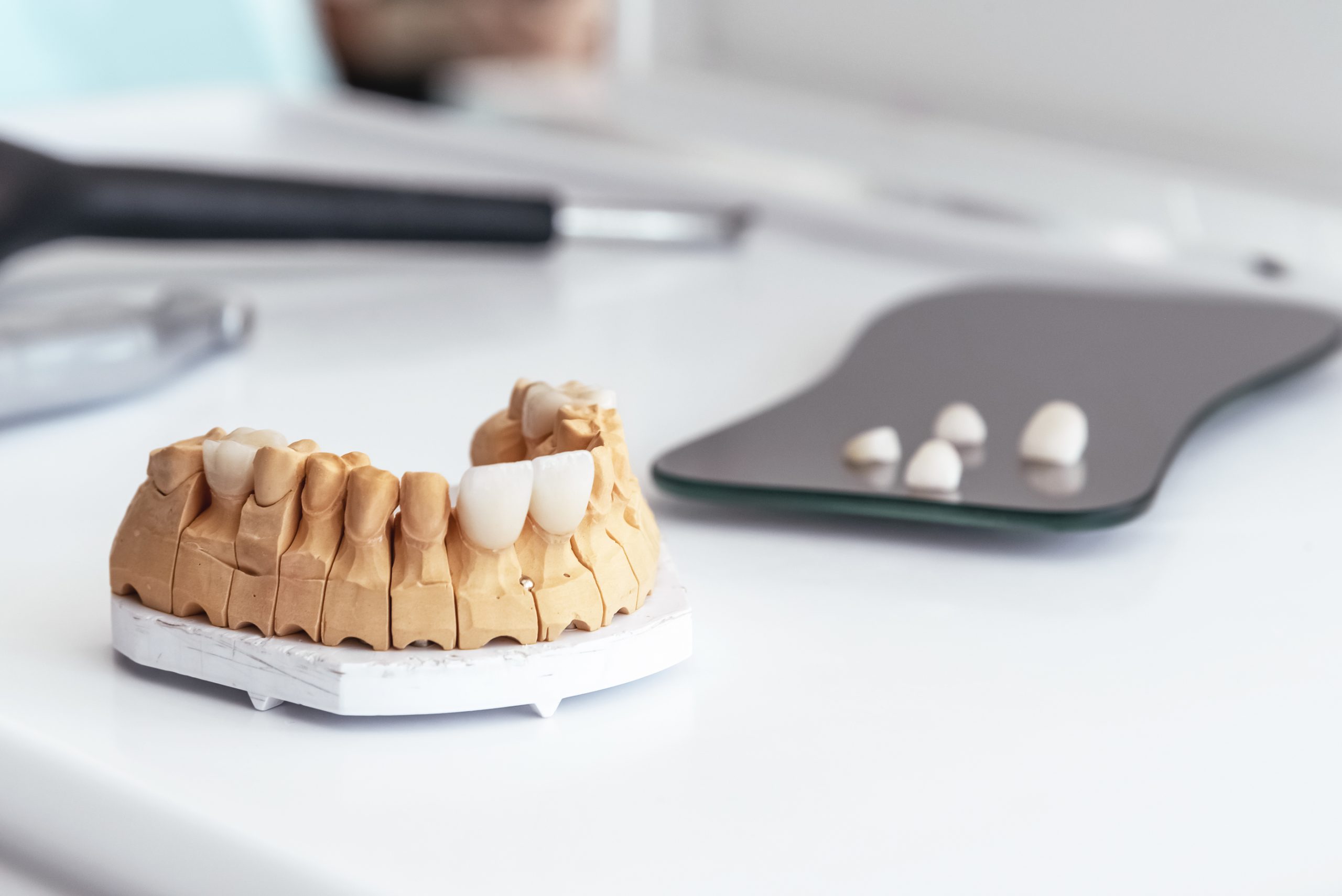 What Can Veneers Do For Sacramento Smiles?